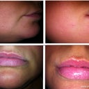 These are before and after pictures of the treatment at five days.