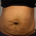 So the ps told me that I have a pretty good size herniated belly button as well....