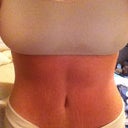 6 months after surgery