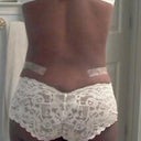 5 1/2 weeks back view still wearing steri tape