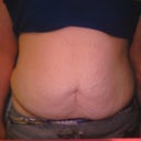 One month prior to tummy tuck