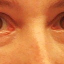 1 month post - still lots of swelling.