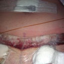 incision