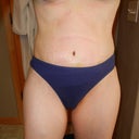 1 week post-op