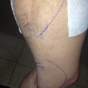 Left leg 3 days post op