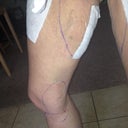 Right leg 3 days post op