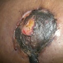 Right nipple as of November 19