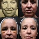 18 years old, Before, 1 week, post, 2 weeks post