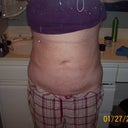 20 days PO still swollen in hip and tummy areas
