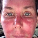 this is what the 3rd day of my 3rd fraxal treatment looked like. Red, swollen, scabby.