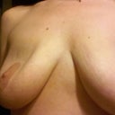 8 days after saline drained. Shells not removed yet. Very dented in with no breast tissue on top.