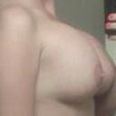 5weeks post op side view