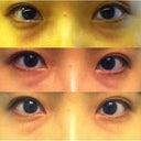 Top: before treatment
Middle: within 10 hrs
Bottom: the morning after