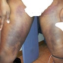 Bruising on my inner thighs. Ugly, but not painful!