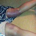 Bruising on the back of my thighs. Eww I hate this pic! But part of the problem was that I was walking TOO much! So take it easy ladies, no more than 20 minutes at a time, then lay down and give your legs a break!