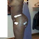 I think this was post op day 5
