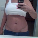 front view almost 4 wks post op