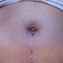 Small infection in the navel at about 4 weeks post op