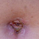 Close up of infection. Antibiotics  cleared it up pretty fast though! It was looking pretty nasty LOL