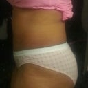 1 month post op...