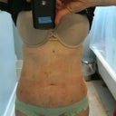 Day 5 Front.  I have the same measurements at my waist as I did preop.