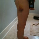 Day 5, right thigh.