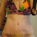 PO day 23 closer look at the tummy incision. Looks darker/uglier than it truly is in this pic due to the lighting.
