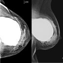 NOTE- this is a mammogram of SOMEONE ELSE! Not me! Just to show what CC might look like underneath. I dont know if this is subglandular or subpectoral