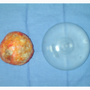 Shows the constriction the scar tissue can have on the implant