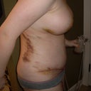 Lovely sore bruises- day 4 post op