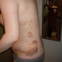 This side is the worse- day 4 post op
