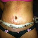 11 days PO. Still haven't been able to take a full shower. can't wait to wash my tummy!