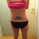 11 days PO.  The doc i saw after seen a dozen was the only one that said I did NOT need lipo!  no more love handles!!  woohoo..  The red marks are from the binder pinching my skin