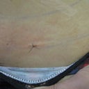 Tiny incision