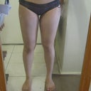 Inner thighs again day 1 post op