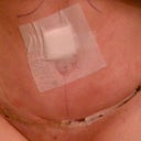 2 days Post Op - after getting stitches cut due to pinched nerve.. so a little swollen but pain is only from pinch nerve nothing else.