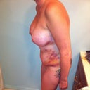 4 days post-op
