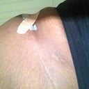 Dog ear revision and the scar