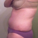 Wk 12 PM Swelling-Looks like Pre op-Even lipo areas swell