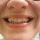 my 'normal' smile, you can't see the bottom pontics or attachments, thankfully.
