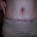 one last one...I pointed to where incision ends on each side.  I am pretty narrow from hipbone to hipbone and was thinking it would go further out on sides.  Know it will only get better!