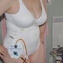 Day 4 post op with drain still in
