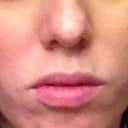 5 and a half months later and my face is  looking more deformed than ever from this mess!