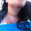 Day 1 post of lip of neck and chin ,,, I never really did bruise much here but I do have stitches behind ears and under chin ,, the purple is marker ,, didnt hurt just like if you had a bruise on your face but I think thats cause my doc out a lot of numbing med cause my chin and neck is still numb when it swells