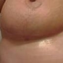 2 mths PO - Left underside