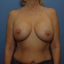after, left breast much larger as well