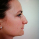 BEFORE - Profile