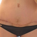 close-up of scar at 8 1/2 weeks