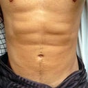 30 days post surgery. Feeling much better now, have started exercising again and am in little to no pain. The area is still a little tender to touch and sore when I stretch but otherwise I'm feeling back to normal.