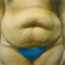 Pre op. the morning of my surgery Jan 28th.